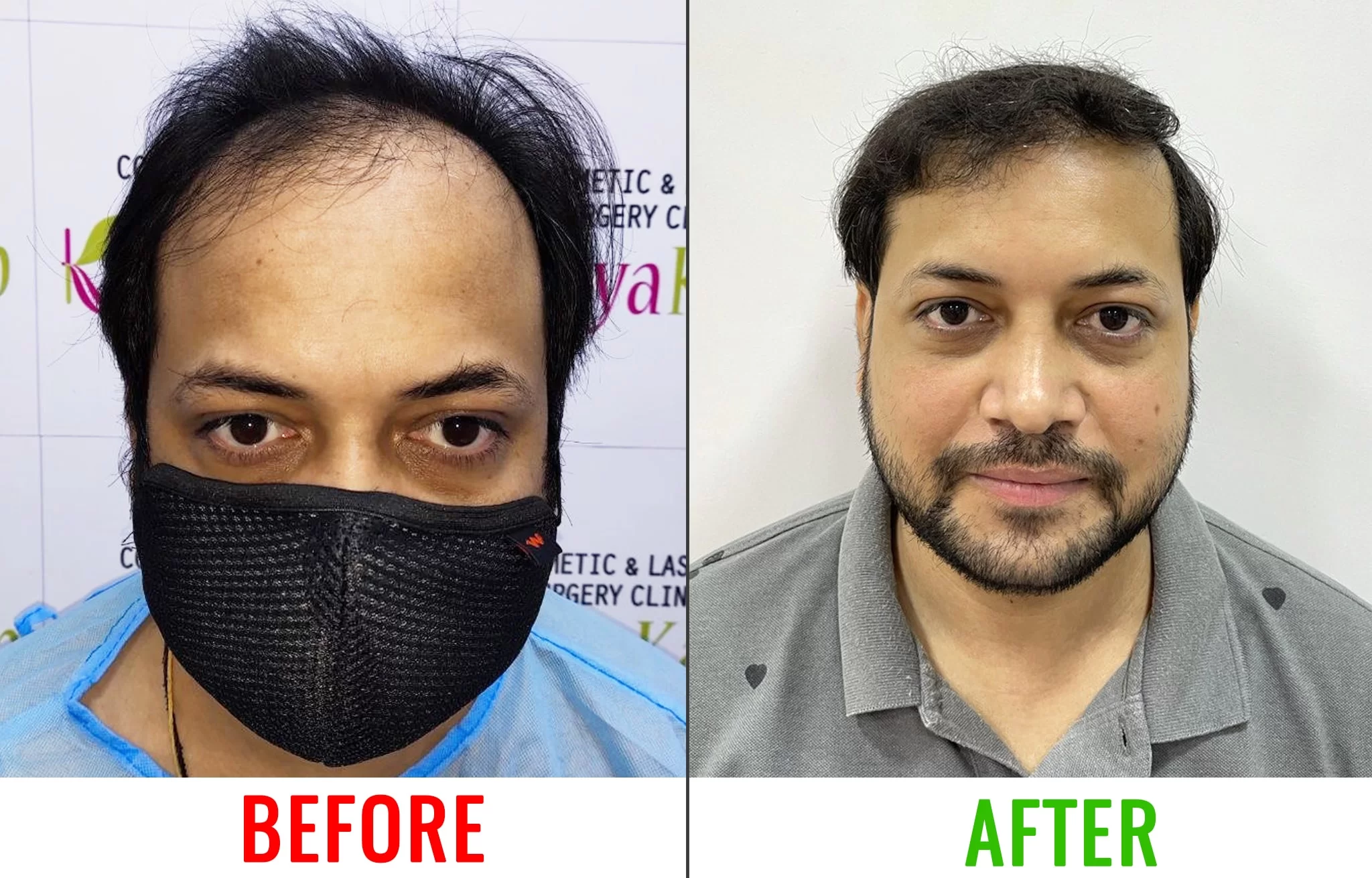 Hair Transplant Clinic in Kolkata | Kaayakalp . S. Rathore